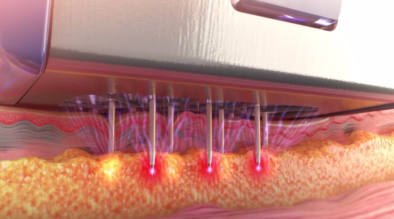 Аппарат Morpheus 8 и процедуры по микроигольчатому RF-лифтингу в МирраМед