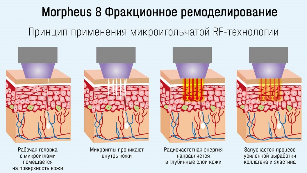 Микроигольчатый RF-лифтинг